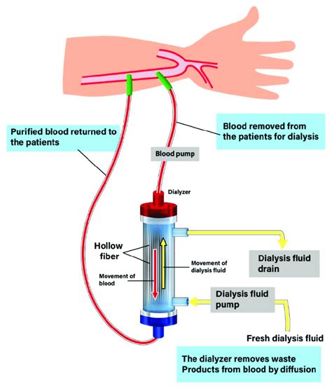 A surgically created AV fistula is. . Which fluid compartment is accessed during hemodialysis